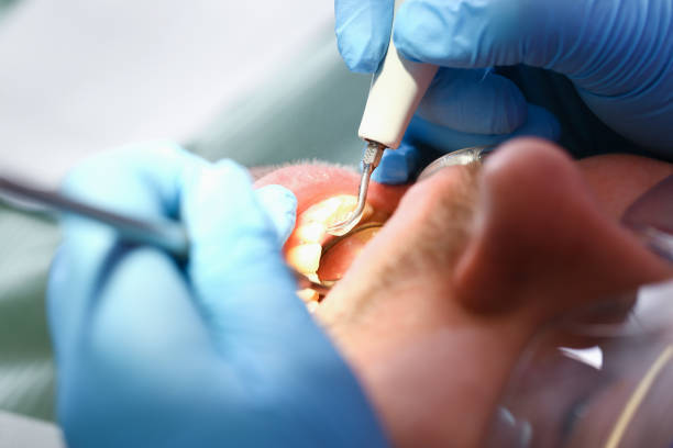 Best Emergency Dental Care for Abscessed Tooth in King Cove, AK